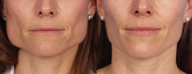 Masseter botox